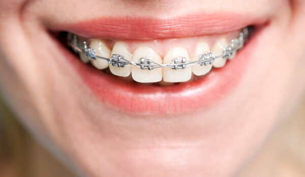 sabit ortodonti