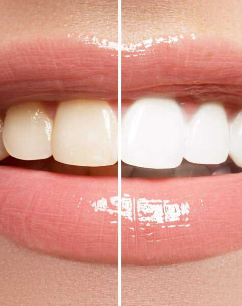 diş beyazlatma 1