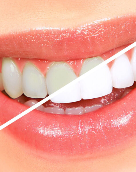 diş beyazlatma 2